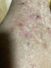 色素脱失した皮膚について質問です 昔からアトピーがあり脚も傷跡だ Yahoo 知恵袋