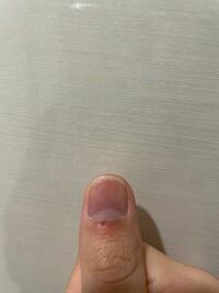 3日前に飼っている犬に親指の爪と皮膚の境界線 を噛まれま Yahoo 知恵袋