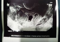 エコー写真あり これは双子ですか 現在5週です 胎嚢2つに Yahoo 知恵袋