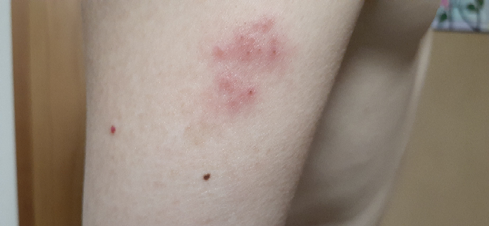 皮膚の病気 アトピー 解決済みの質問 Yahoo 知恵袋