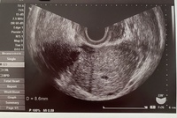 Bt18日目 5w2d で8 6mmの胎嚢が確認できました Yahoo 知恵袋