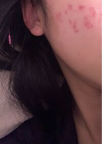 このような赤いニキビ跡が治りません 1ヶ月前から皮膚科で漢方薬 塗 Yahoo 知恵袋