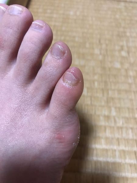 水虫 解決済みの質問 Yahoo 知恵袋
