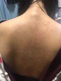 背中のニキビに困っています ニキビ用の薬を買ってみたり皮膚科に行って薬 Yahoo 知恵袋