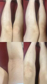 私はアトピーです 見ての通り足がとても汚いのですが これで外を歩 Yahoo 知恵袋