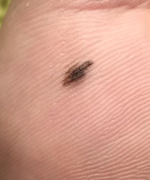 メラノーマ 心配性 に関するq A Yahoo 知恵袋