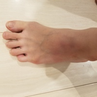 足のこうに茶色ような紫っぽいような変色があって心配です いつ Yahoo 知恵袋