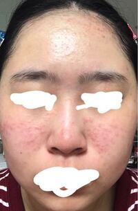 肌荒れが治りません これは何ニキビですか それともアトピーとかです Yahoo 知恵袋