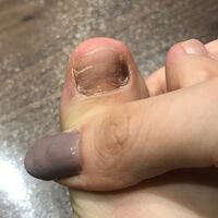 足の爪の変色について 足の親指の爪が変色し ひび割れと表面がでこぼこ Yahoo 知恵袋