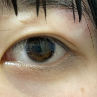 ヘアアイロンでまぶたを火傷してしまいました 冷やしたのですが Yahoo 知恵袋