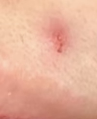 唇と鼻の間にできたでき物です 汚くてすみません できてから5日くらいた Yahoo 知恵袋