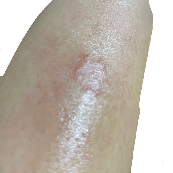 足 すね辺り に画像にあるかぶれ のようなものがあります かゆいです Yahoo 知恵袋