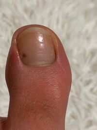 ふと足を見たら足の親指に黒い点が出来ていました これは皮膚がん または Yahoo 知恵袋