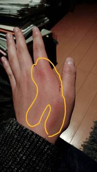 助けてください 突然昨日の朝起きたら手の1部が赤くなっていて Yahoo 知恵袋