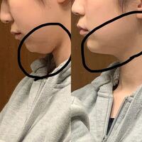 17歳 下膨れ たるみで困っています 最近気づいたので Yahoo 知恵袋