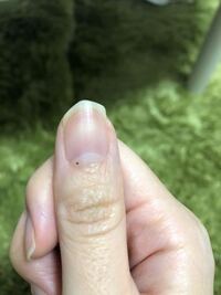 ほくろいきなり出来た人いますか 爪の生え際にここ1ヶ月いきなりで Yahoo 知恵袋