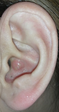 耳に粉瘤の様な物ができ 触ると痛い時がありました 今は固まっ Yahoo 知恵袋
