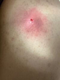 閲覧注意粉瘤ができたと思い 針でめくって潰そうとしても血しか出てきませ Yahoo 知恵袋