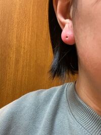 ピアスを開けて気づいたらこんなになってました どうすればいいですか Yahoo 知恵袋