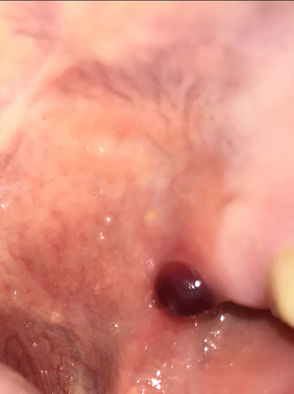 授乳 ち首が痛い 血豆