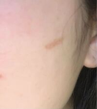 顔の火傷跡の治し方について 一ヶ月前にヘアアイロンで頬に Yahoo 知恵袋