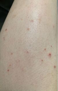 足の痒みについて質問です 夜になると膝から下だけが痒くて最初は何 Yahoo 知恵袋