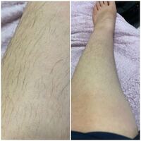 女性すね毛 汚い写真失礼します 家庭用脱毛器のケノンを検討中の者 Yahoo 知恵袋