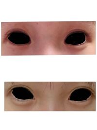 目頭が何年か前からずっと痒くて掻いていたら目頭が開いたというか目の形が Yahoo 知恵袋