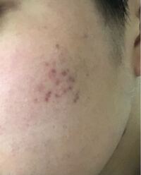 赤いニキビ跡が治りません18歳男です ビタミン剤を2ヶ月ほど Yahoo 知恵袋