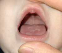 4ヶ月の赤ちゃんの舌に白いものが出来ていました 写真のこれはカビ Yahoo 知恵袋