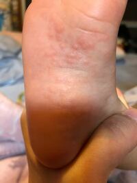 子供 1歳2ヶ月の女児 の足と手のひらの湿疹について Yahoo 知恵袋