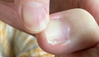 足の爪の端が白くぼこぼこなっていて 黄ばみも見られ 若干かゆ Yahoo 知恵袋