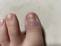 ひょう疽になりました ネイルが原因です 2週間ほどこの Yahoo 知恵袋