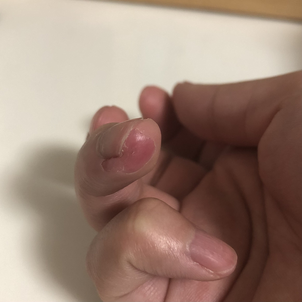 皮膚の病気 アトピー 解決済みの質問 Yahoo 知恵袋