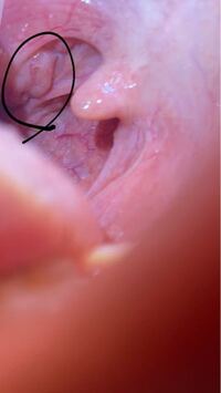 喉の写真載せてます 今日の朝起きて右側の喉が痛いと思い 喉 Yahoo 知恵袋