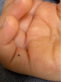 2歳の娘の手に1 2週間前からあります これは黒子ですか 血豆で Yahoo 知恵袋