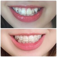 歯列矯正を始めて2週間なのですが これだけ動きました スピードが速すぎ Yahoo 知恵袋