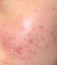 元々顔の頬に酷く赤ニキビばかりありました Cica系のスキンケアを使い Yahoo 知恵袋