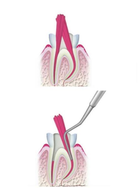 根管治療について虫歯歯の神経 今度２回目の根管治療をやります 内容 Yahoo 知恵袋