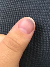 中3の娘が体育の授業で男の子の投げたバレーボールが爪にぶつかり 写真の Yahoo 知恵袋