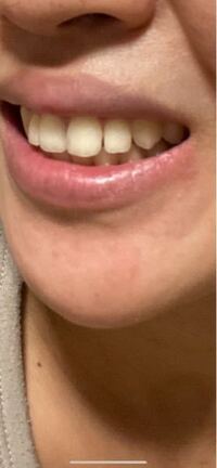 歯と歯の隙間目立ちますか 歯列矯正が終わってリテーナー Yahoo 知恵袋