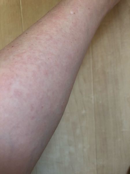 皮膚の病気 アトピー すべての質問 Yahoo 知恵袋