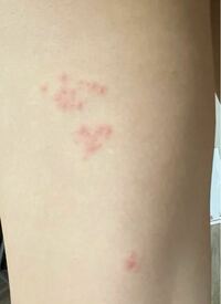 これは帯状疱疹でしょうか 片方の太腿に変な痛みが出てから数日経過 Yahoo 知恵袋