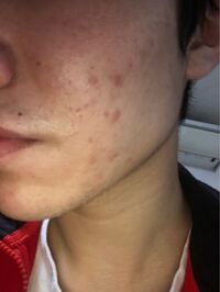 お恥ずかしいですがこんなニキビ跡や ぶつぶつを治す方法を教え Yahoo 知恵袋