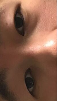 影による黒クマ対策は病院 皮膚科 整形外科のいずれかにいくし Yahoo 知恵袋