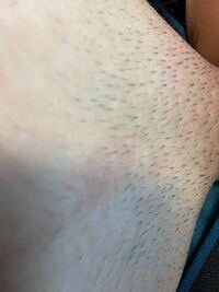 汚い写真がありますご注意ください 陰毛の剃り跡が気持ち悪くてこまっ Yahoo 知恵袋