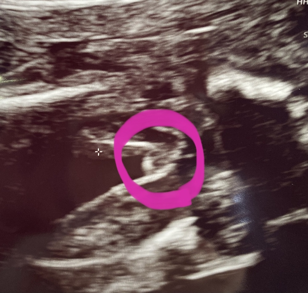 今日産婦人科で赤ちゃんのお股のエコーを見てもらい 多分女の子 Yahoo 知恵袋