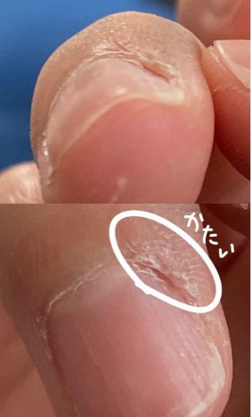 ペンを握る力が強いせいでペンだこができて爪が変形してしまっています Yahoo 知恵袋