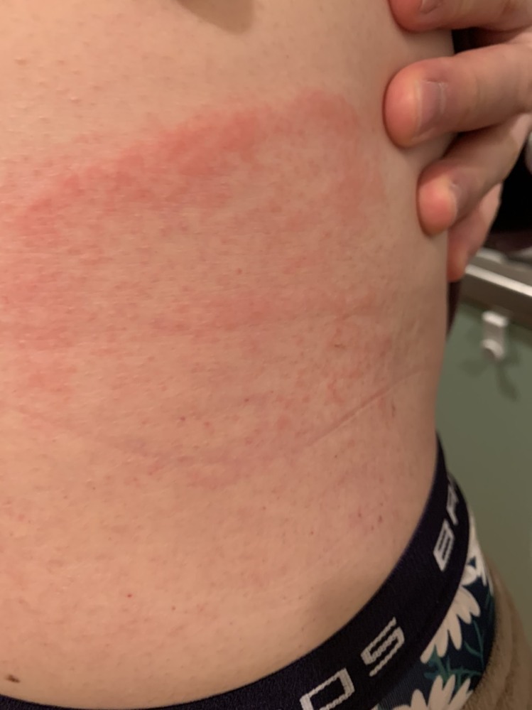 右腰の脇腹付近が数日前から皮膚がヒリヒリしていて時々ズキズキ Yahoo 知恵袋