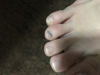 山登りしたときに 靴擦れして右足の薬指が内出血なのか黒くなってて Yahoo 知恵袋